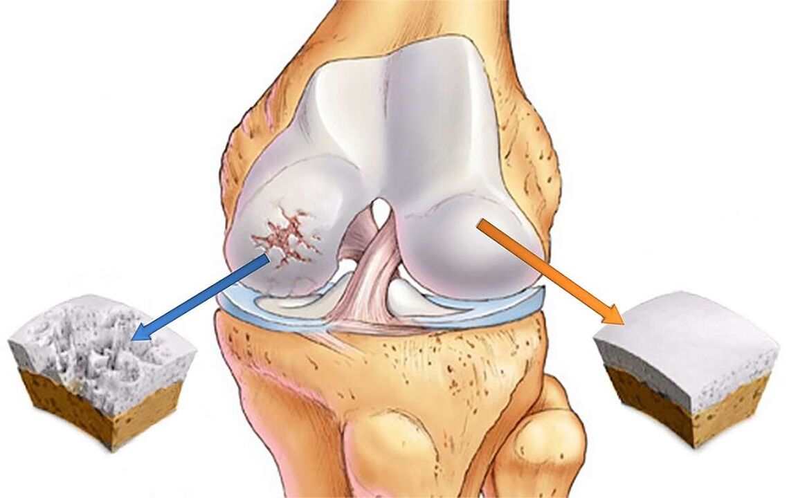Distruzione della cartilagine dell'articolazione del ginocchio con gonartrosi