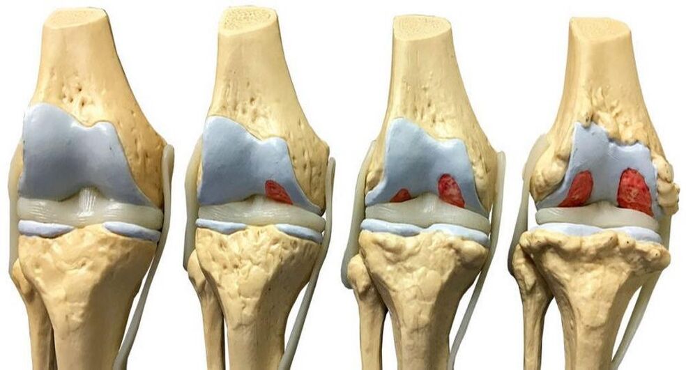 Fasi di sviluppo dell'artrosi dell'articolazione del ginocchio