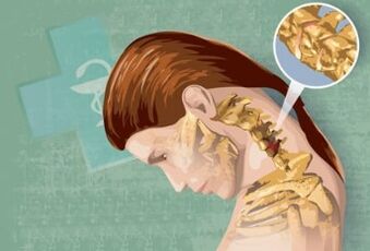 Sintomi riflessi di osteocondosi cervicale