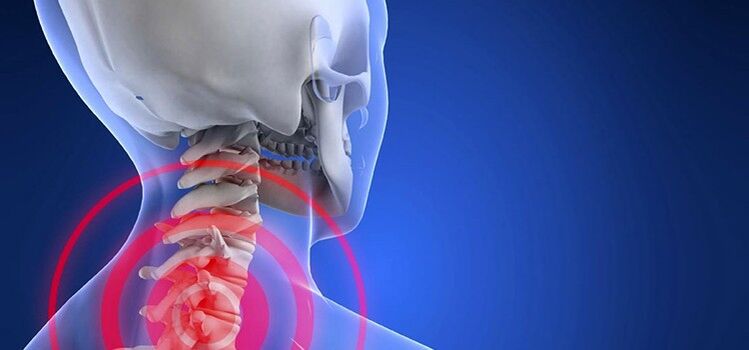 Osteocondrosi del rachide cervicale