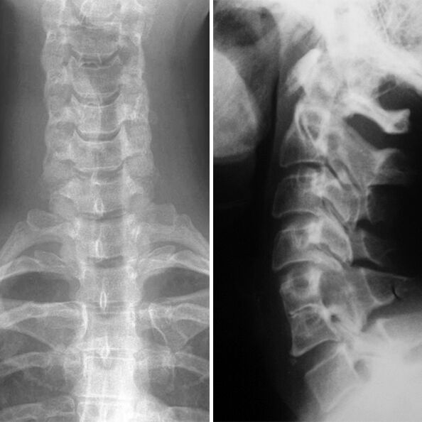 Radiografia del rachide cervicale
